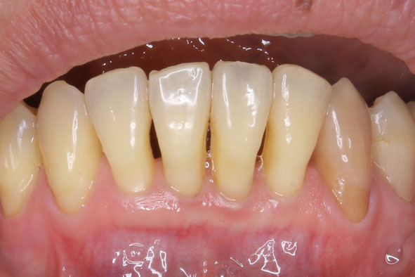 歯と歯の間と表側の歯茎の再生治療ケース　
