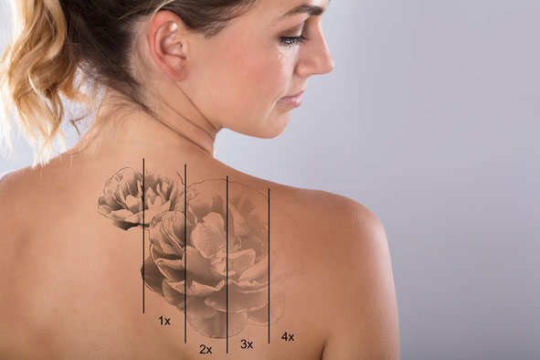 Tattooentfernung Bamberg Laser