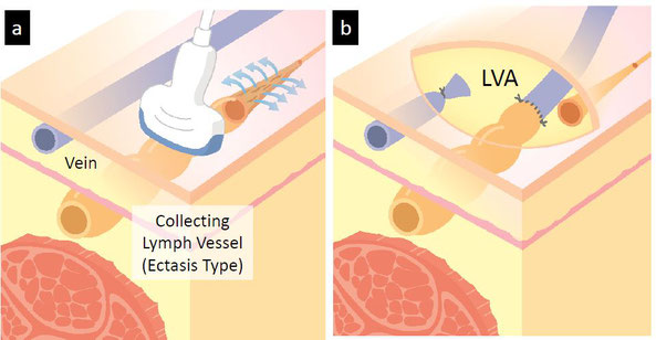 リンパ浮腫　重症　日帰りLVA手術　静脈　リンパ管　三原誠
