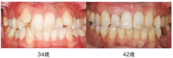 矯正＆オールセラミッククラウンの症例