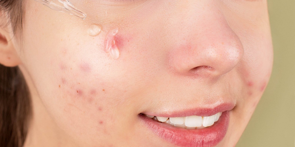 acne naturopathie