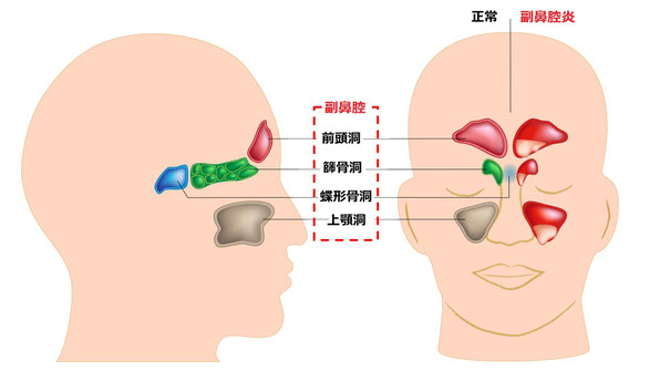 副鼻腔炎
