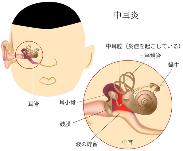 急性中耳炎 茨木市の小児科 はら小児科クリニック