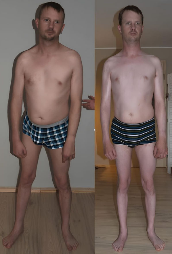 Patient vor der der ersten Sitzung Senmotic Faszien Therapie und auch der sechsten Sitzung in Frontalansicht