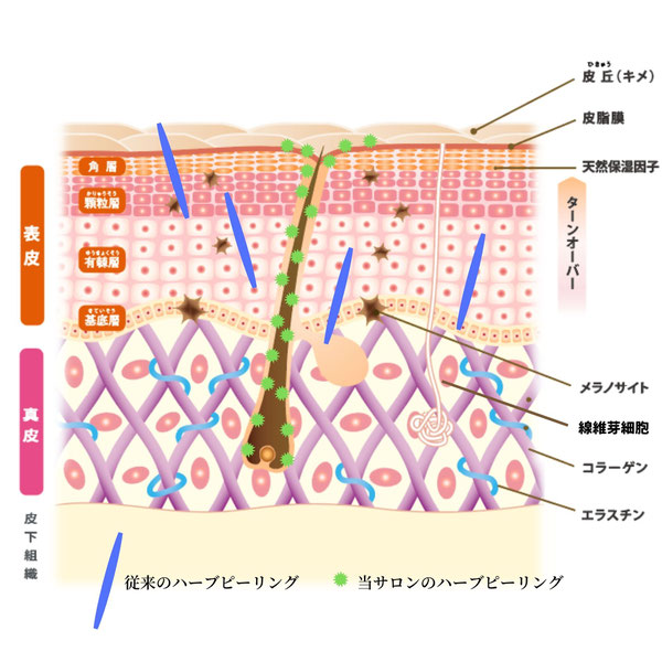 OHLハーブピーリングは棘状ではなく、微粒子化したハーブピーリングパウダー自体を棘のある球体とし、毛穴から導入する為、痛みや剥離が起こりません。