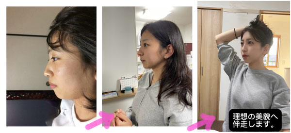 小顔矯正（輪郭のシェイプアップ 施術前後比較）