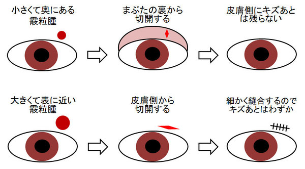 尼崎　眼科　緑内障　日帰り白内障手術　霰粒腫　めばちこ　切開　