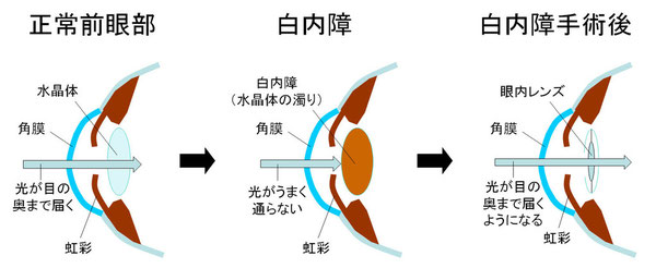 尼崎　眼科　緑内障　日帰り白内障手術