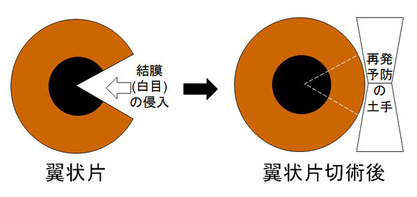 尼崎　眼科　緑内障　日帰り白内障手術　翼状片　目わた