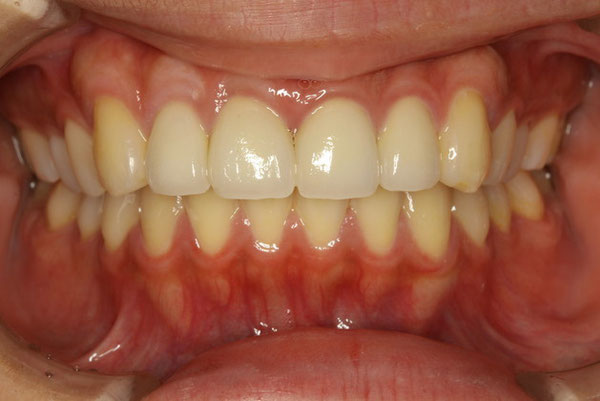 歯茎の再生とオールセラミックで治療