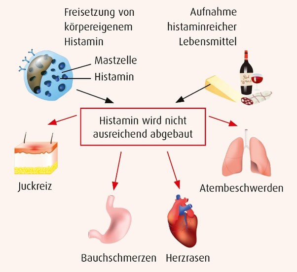 Histaminintoleranz natürlich behandeln