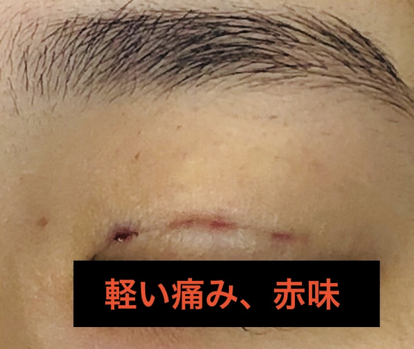 埋没後の痛み・赤味