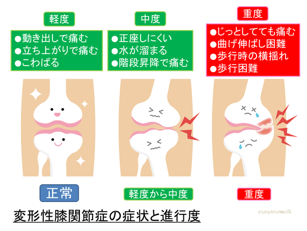 変形性膝関節症の進行度、昭島市のオサモミ整体院