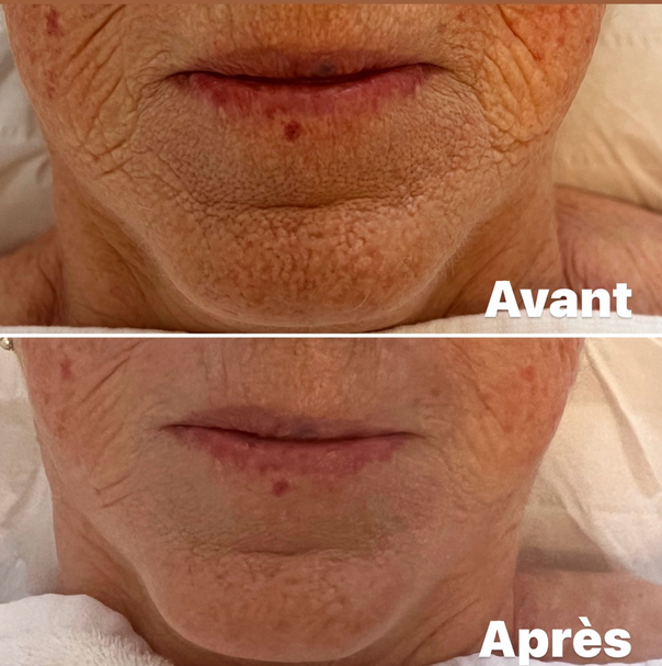 Avant/Après 1 séance microneedlind visage complet: tient unifié et taches pigmentaires atténuées; pore resserrés, peau plus lisse et lumineuse, rides estompées. Effet glow