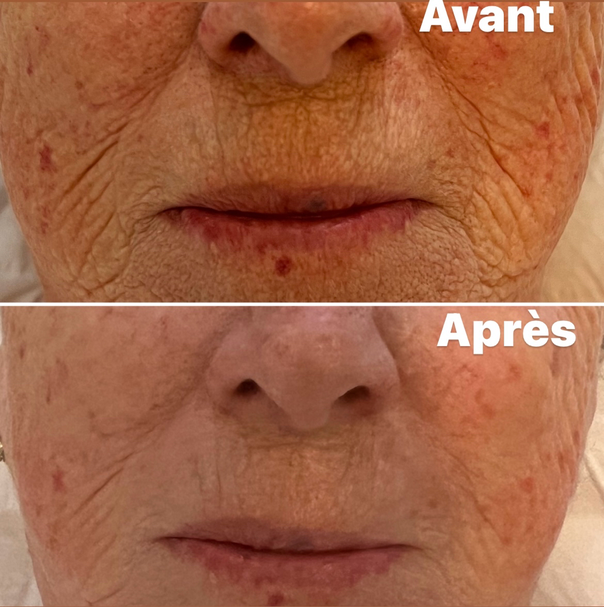 Avant/Après 1 séance microneedlind visage complet: tient unifié et taches pigmentaires atténuées; pore resserrés, peau plus lisse et lumineuse, rides estompées. Effet glow