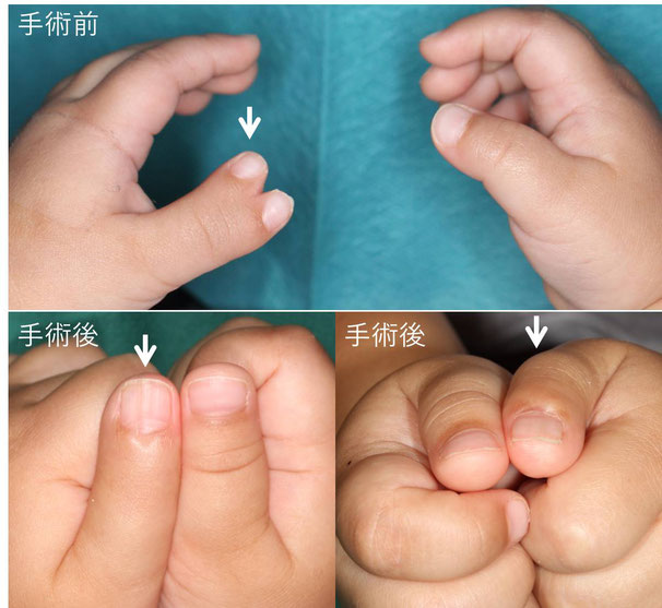 母指多指症　レベルⅢ　手術前と手術後