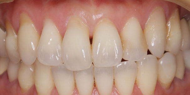 リグロスを併用した歯茎の再生治療