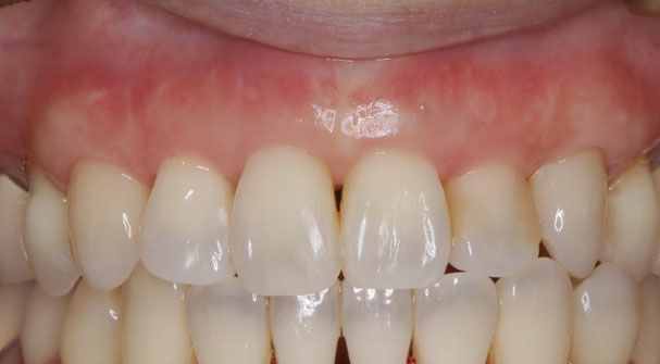 歯ぐきの再生治療とリグロス