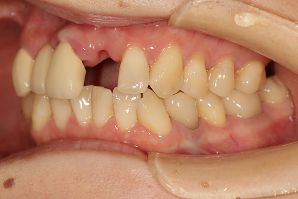 歯を抜いた後、１か月入れ歯を入れていた方の歯茎のくぼんだケース