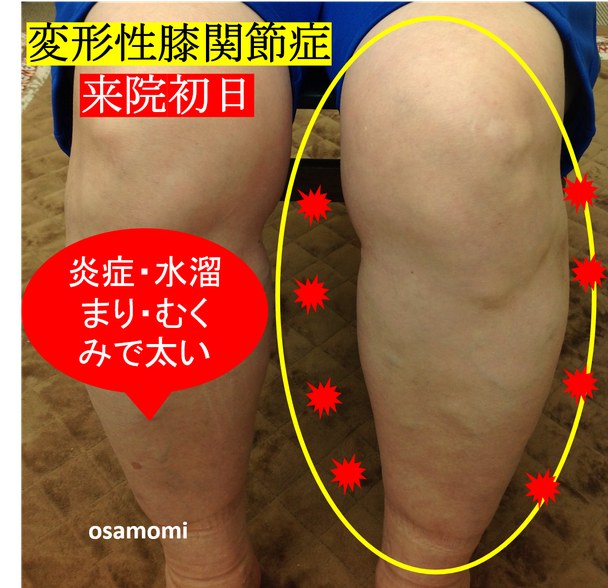 オサモミ整体院 変形性膝関節症 ひざ痛
