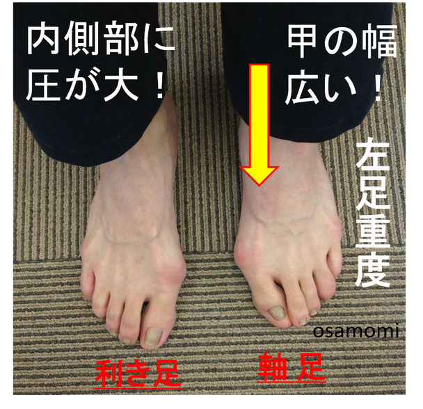 オサモミ整体院 外反母趾 股関節異常