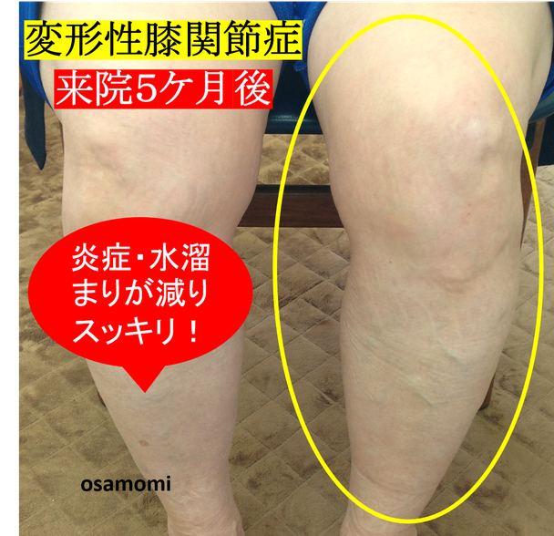 オサモミ整体院 変形性膝関節症 脚太り むくみ