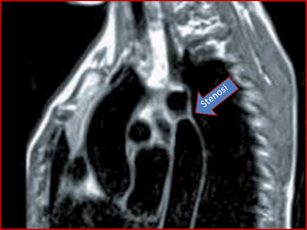 La risonanza magnetica  (RM) consente di definire meglio l'anatomia della coartazione i- stmica. E' più vantaggiosa rispetto ad angiografia,ecografia e tomografia computerizza-ta. Nella figura è ben evidente la membrana a livello della coartazione.