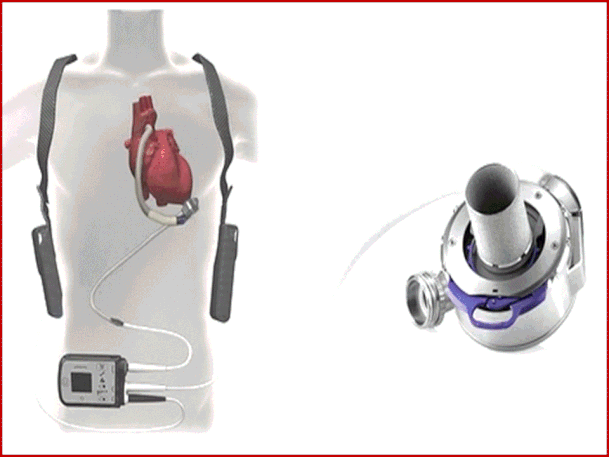 evice di assistenza ventricolare sinistra nello scompenso cardiaco avanzato: l’esperienza con Heartmate 3. 