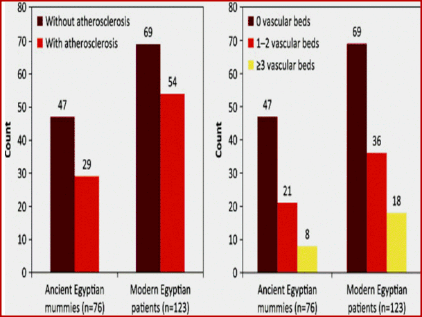 Presenza o assenza di calcificazioni vascolari e compromissione del numero di vasi  nelle mummie e negli egiziani moderni escludendo i pazienti > 60 anni.