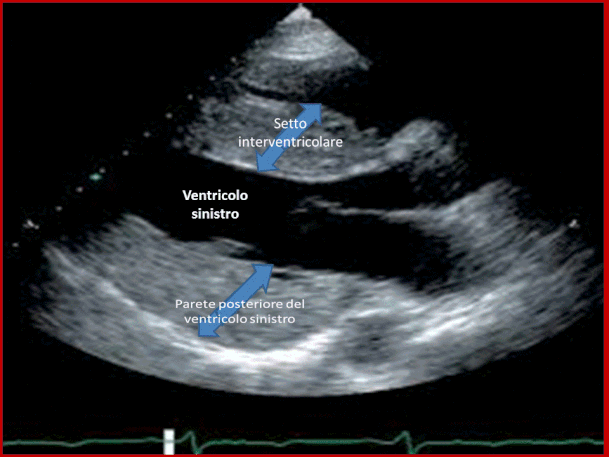 Ecocardiogramma che mostra il setto interventricolare e la parete posteriore del ventri-colo sinistro notevolmente ingranditi in un paziente con cardiomiopatia ipertrofica.