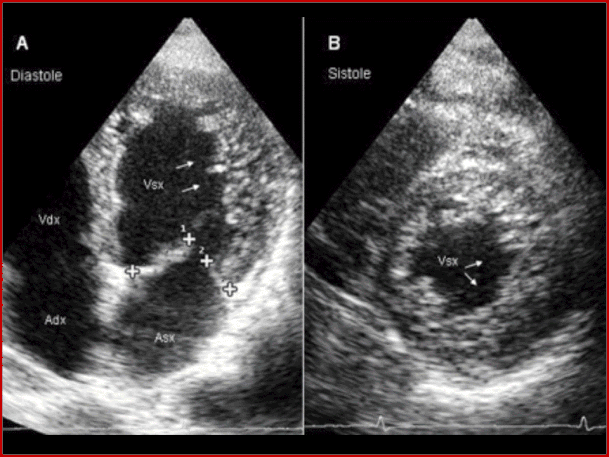 G Ital Cardiol 2010; 11 (5): 377-385.Ecocardiografia bidimensionale in un uomo di 52 a. affetto da ventricolo sin."non compatto" isolato. Proiezione apicale 4 camere (A) e  asse corto parasternale (B). Le frecce indicano la "non compattazione".