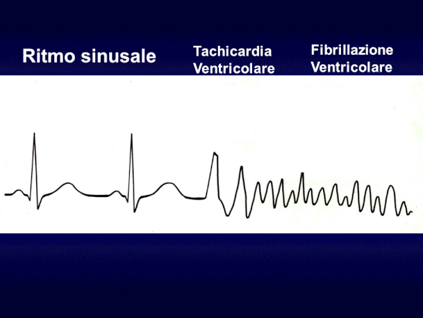 Elettrocardiogramma che mostra un ritmo sinusale,a cui segue un breve run di tachicar-dia ventricolare che evolve verso la fibrillazione ventricolare. 