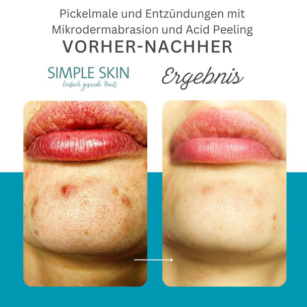 Vorher Nachher Entzündungen und Pickelmale mit Mikrodermabrasion und Acid Peeling