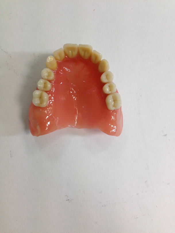 Im ersten Bild zeigen wir eine Oberkiefer Totale Prothese die individuell angefertigt wird, bei Patienten die keine eigenen natürlichen Zähne mehr haben.