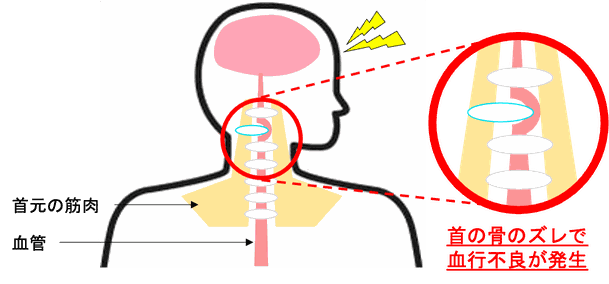 首元の筋肉、血管、首の骨のズレで血行不良が発生