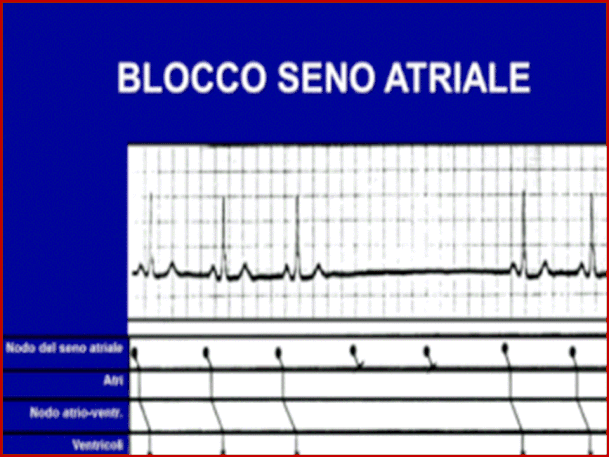 le-aritmie-cardiache-gennarino-borrello