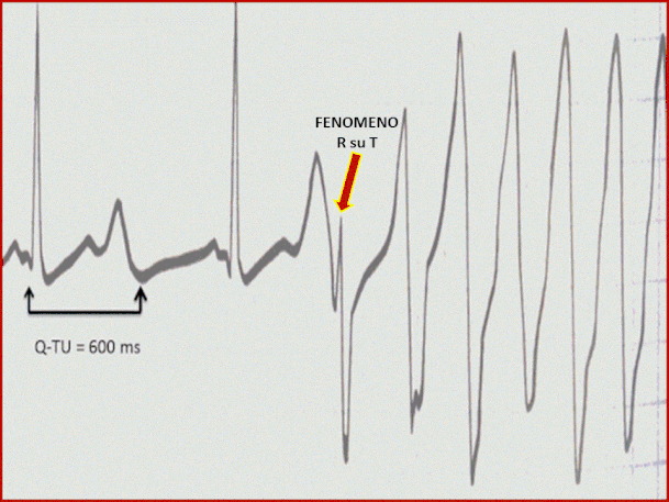 Paziente (19 a) con Sindrome del Q-T lungo congenito (Q-T = 600 ms). L'onda T-U è al-ternante. Una extrasistole che cade nella fase discendente del tratto  QT-U  innesca un e- pisodio di tachicardia ventricolare. Da Hayes D e Zipes DP, Elsevier Masson.