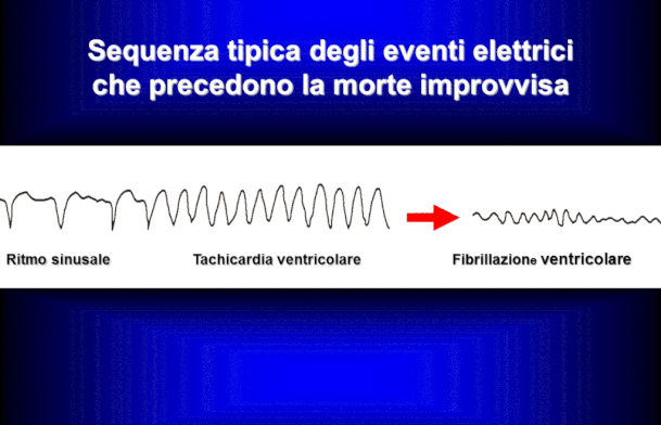 *Chi è a rischio di morte improvvisa - gennarino borrello