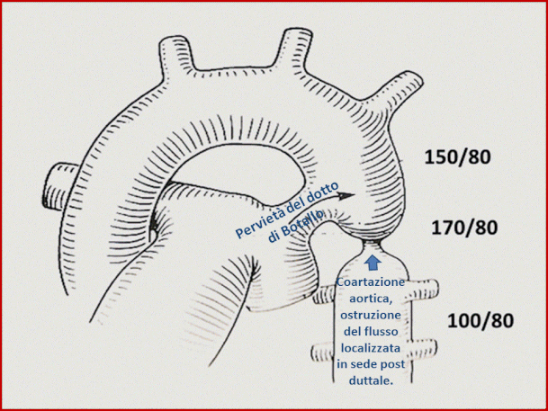 La coartazione dell'aorta nel bambino si associa quasi sempre alla pervietà del dotto di Botallo. 