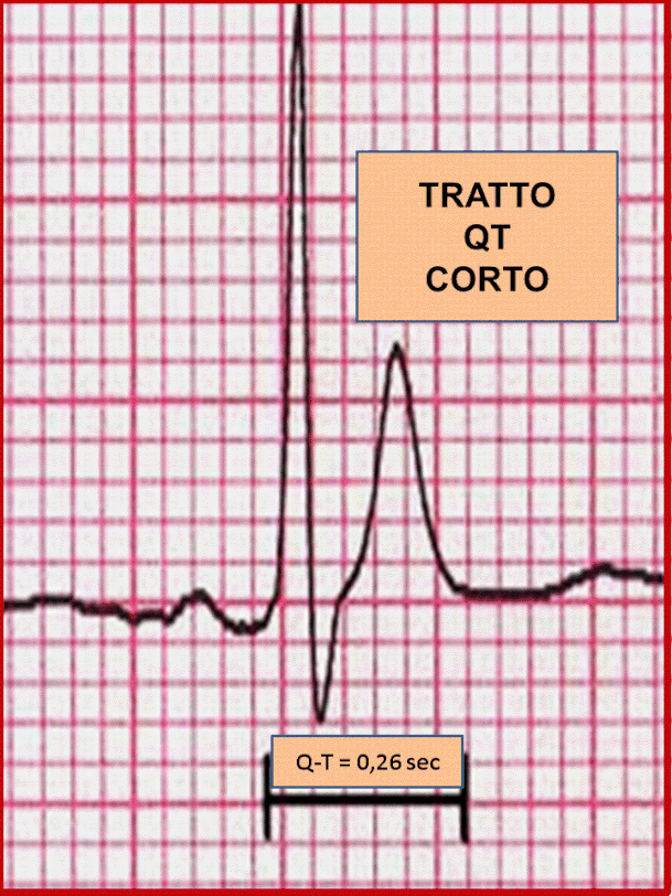 Elettrocardiogramma che mostra un tratto Q-T corto.