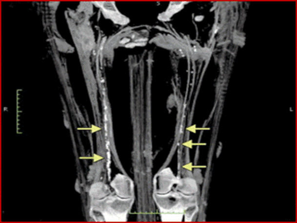 Aterosclerosi delle arterie poplitee e tibiali:diffuse calcificazioni lungo il decorso  delle ar- terie in una mummia egizia di un uomo vissuto durante la 18th Dinastia (Hatiay, Mum- my) JACC 2011, 4: 315- 327.