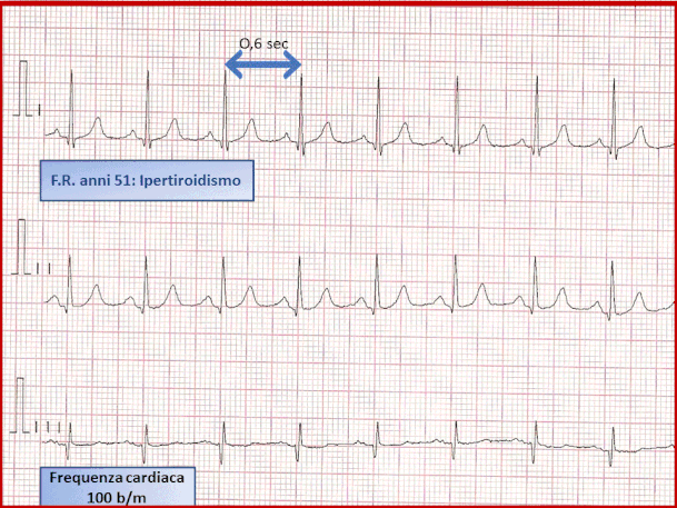 Esempio di tachicardia sinusale in un paziente affetto da ipertiroidismo.