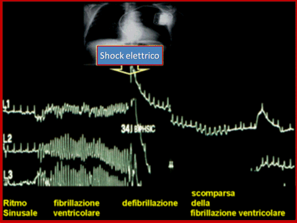 Paziente impiantato con ICD. La presenza di un episodio di Fibrillazione ventricolare fa scattare una scarica elettrica che  ripristina il ritmo sinusale.  