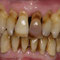 Nach der Behandlung erkennt man wie viel Zahnhalteapparat verloren gegangen ist