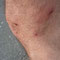 Attaque de moustiques