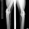 Ellbogen / elbows