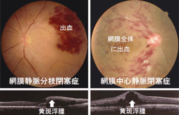 尼崎　眼科　緑内障　日帰り白内障手術　網膜静脈閉塞症　網膜静脈分枝閉塞症　網膜中心静脈閉塞症