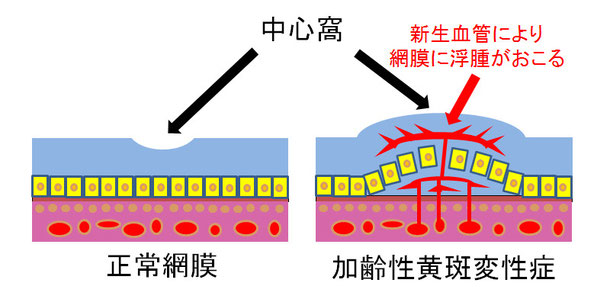 尼崎　眼科　緑内障　日帰り白内障手術　加齢性黄斑変性