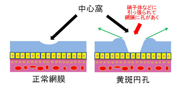 尼崎　眼科　緑内障　日帰り白内障手術　黄斑円孔