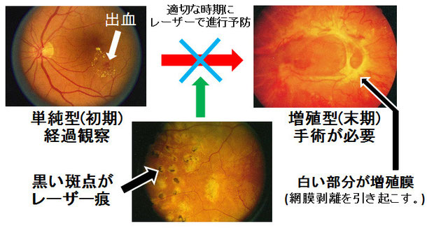 尼崎　眼科　緑内障　日帰り白内障手術　糖尿病網膜症　